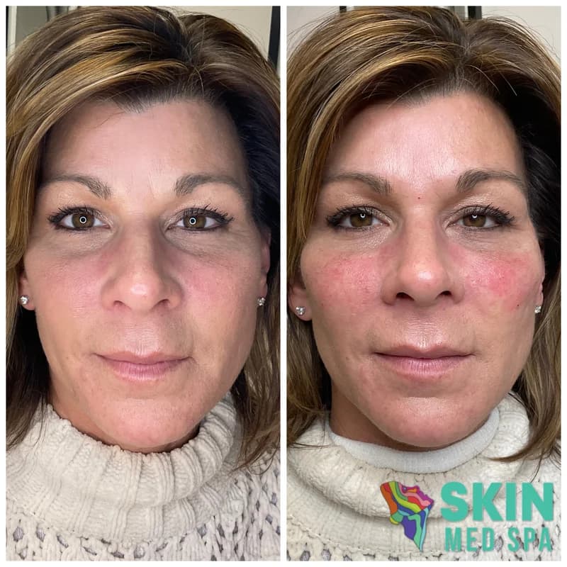 Before and after facial rejuvenation results at Skin Med Spa
