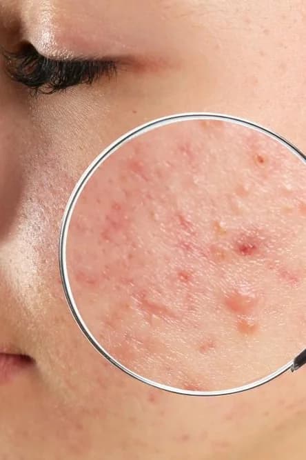 Acne Treatments at Skin Med Spa