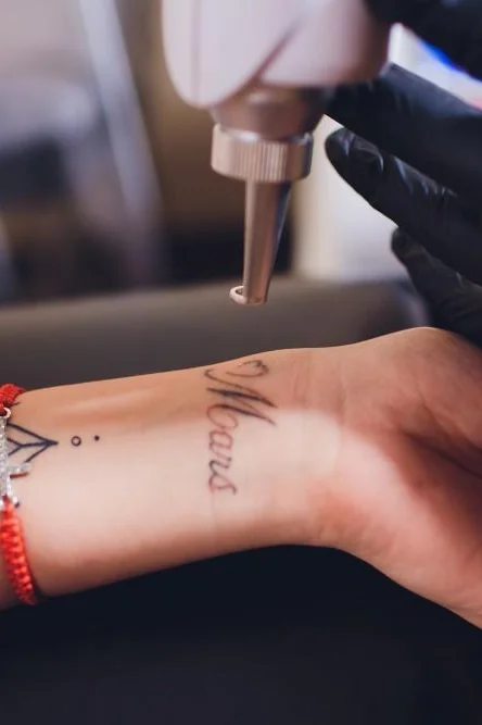 Laser Tattoo Removal — Laser at Skin Med Spa
