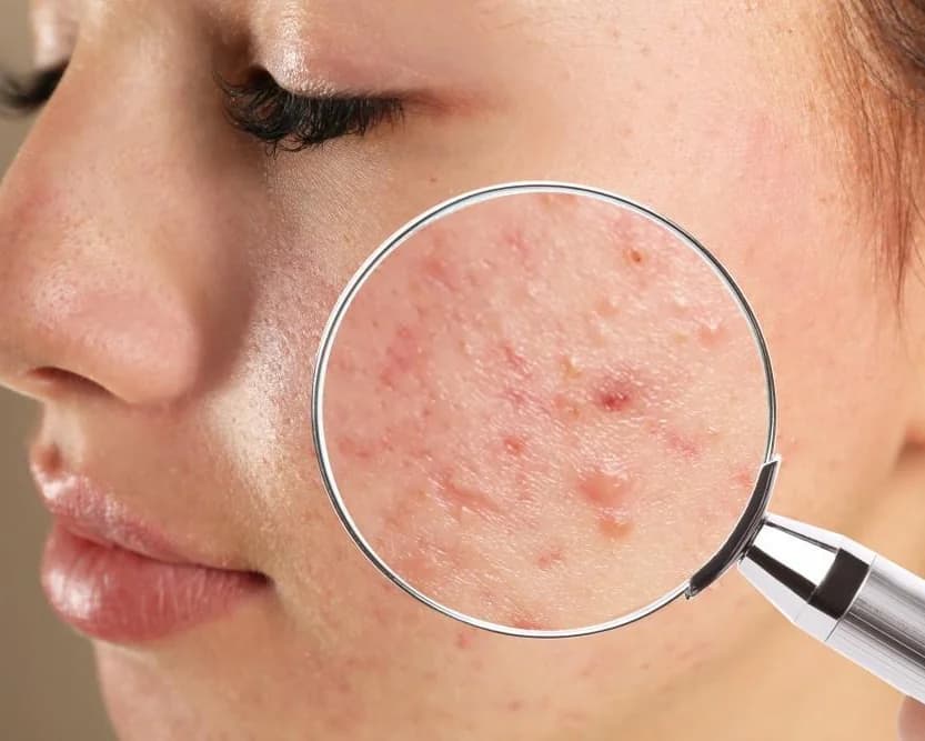 Acne & Breakouts treatments at Skin Med Spa in Downers Grove