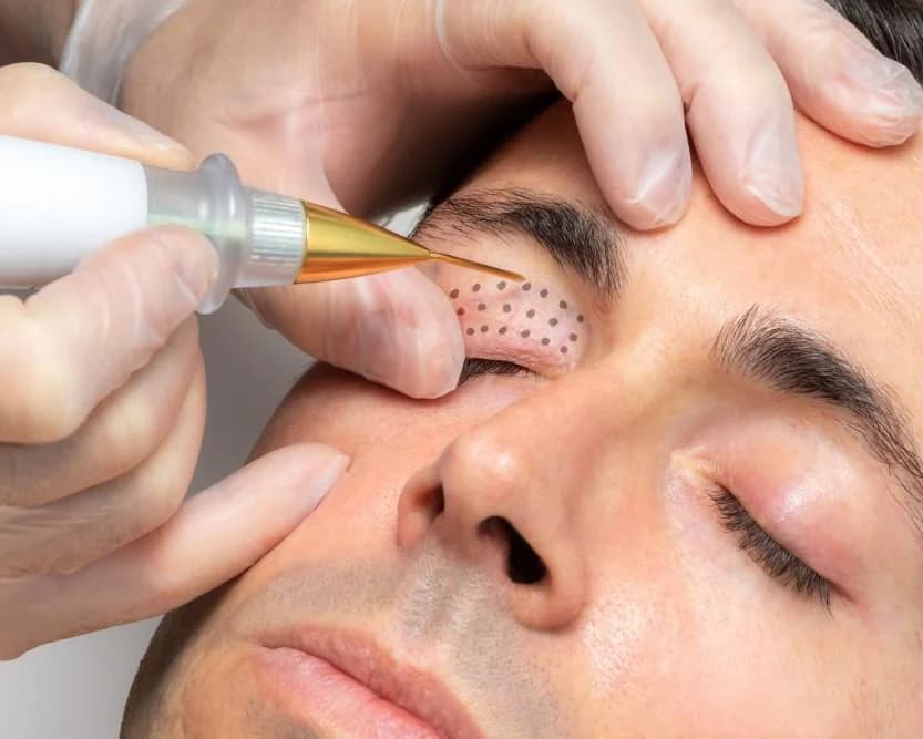 Fractional plasma handpiece treating marked-out skin beneath the eye