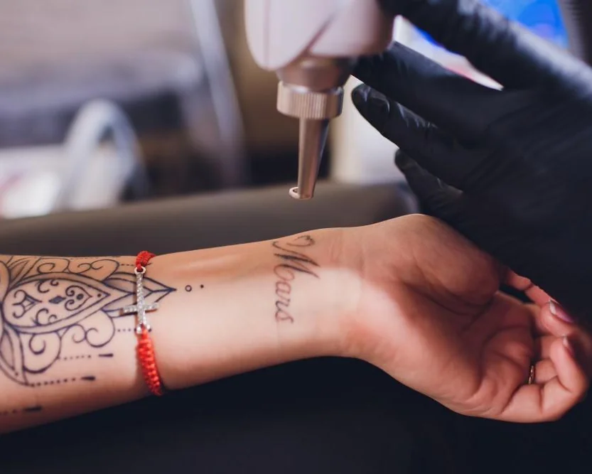 Q-switched laser handpiece passing over a wrist tattoo